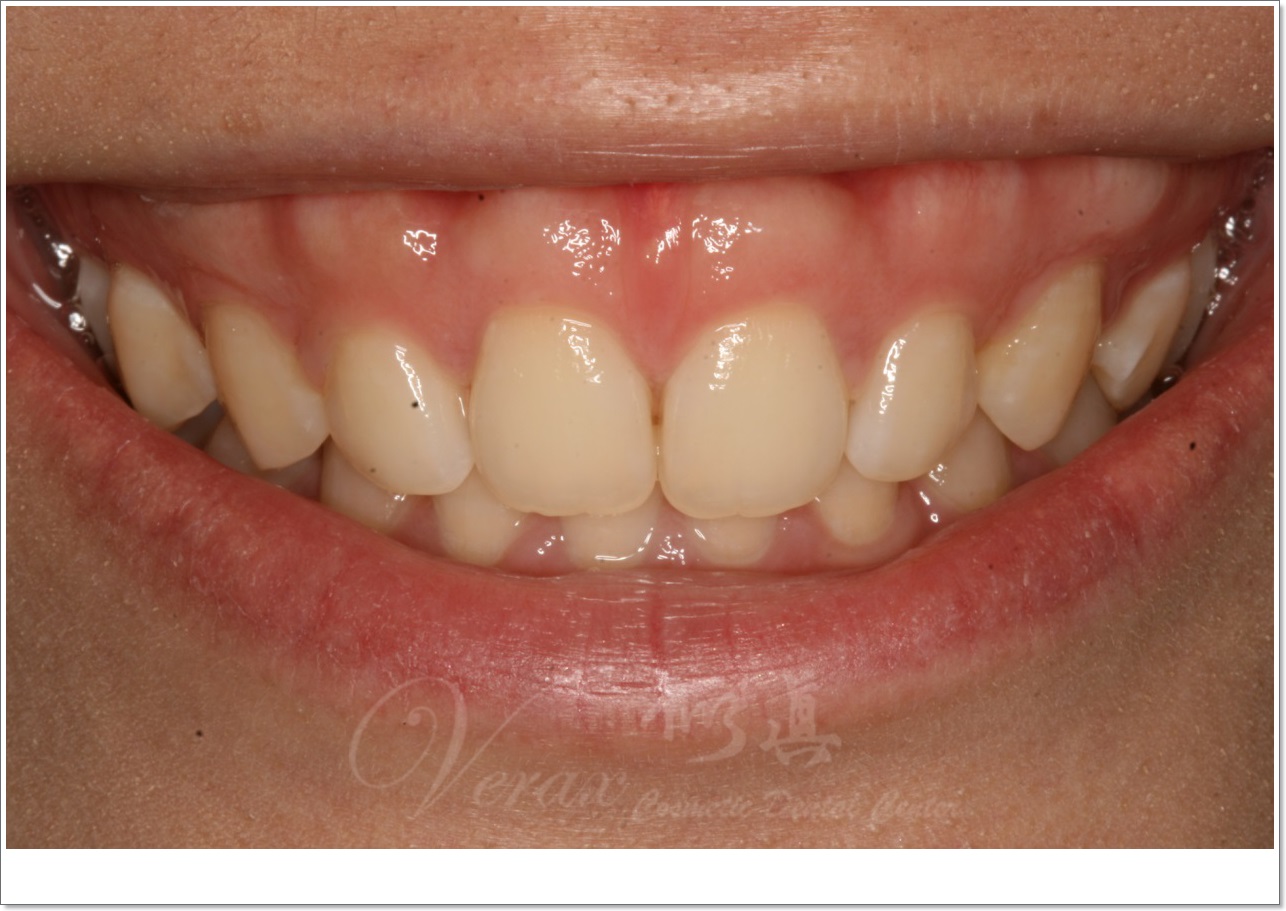 waterlase gums cosmetic surgery