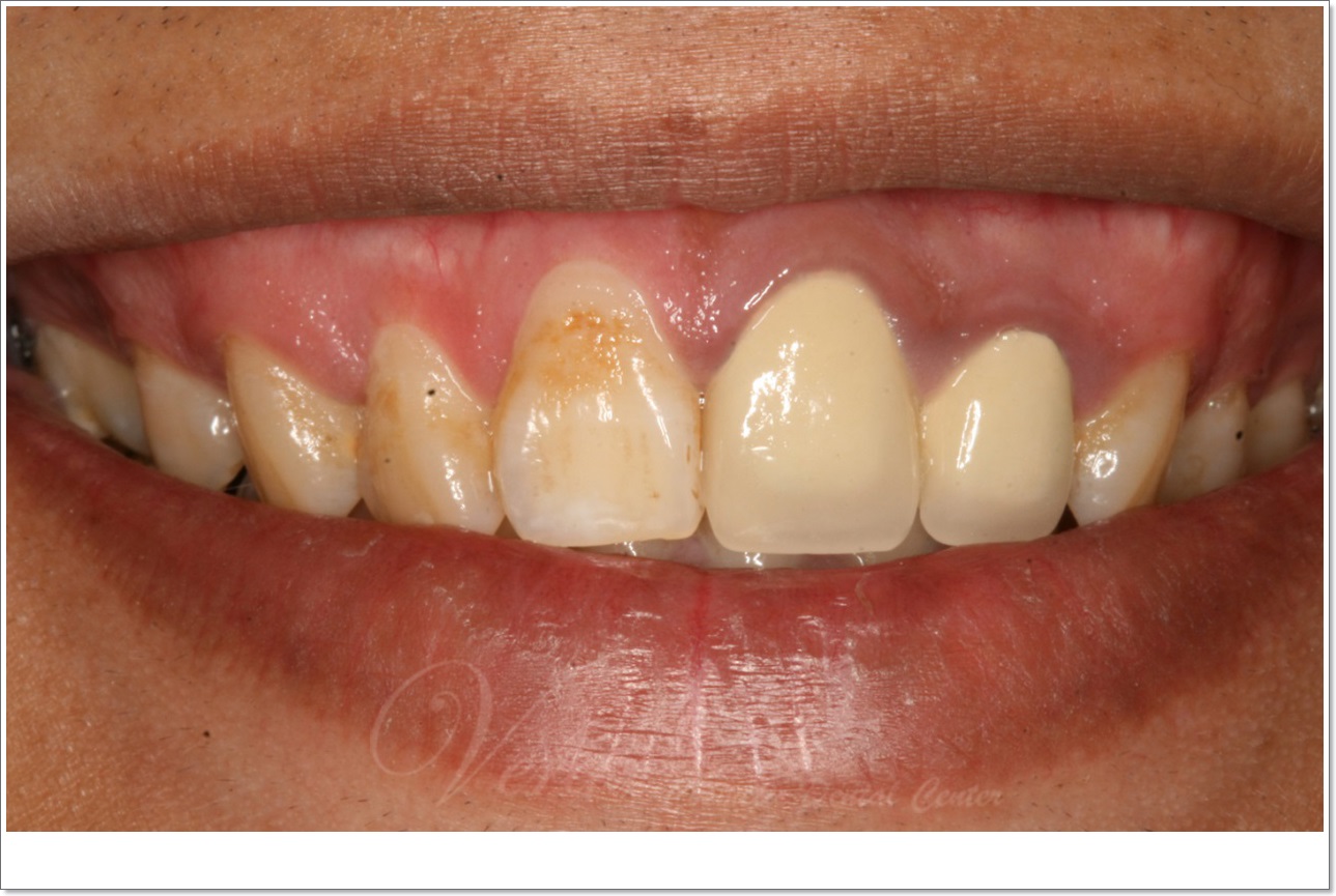 waterlase gums cosmetic surgery